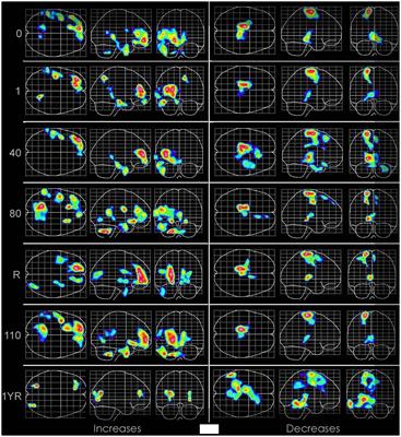 Acute and chronic central nervous system oxidative stress/toxicity during hyperbaric oxygen treatment of subacute and chronic neurological conditions